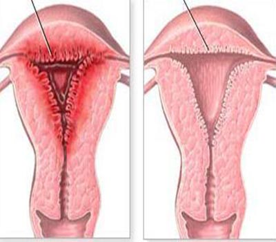 女性子宫内膜炎的症状是怎样的？