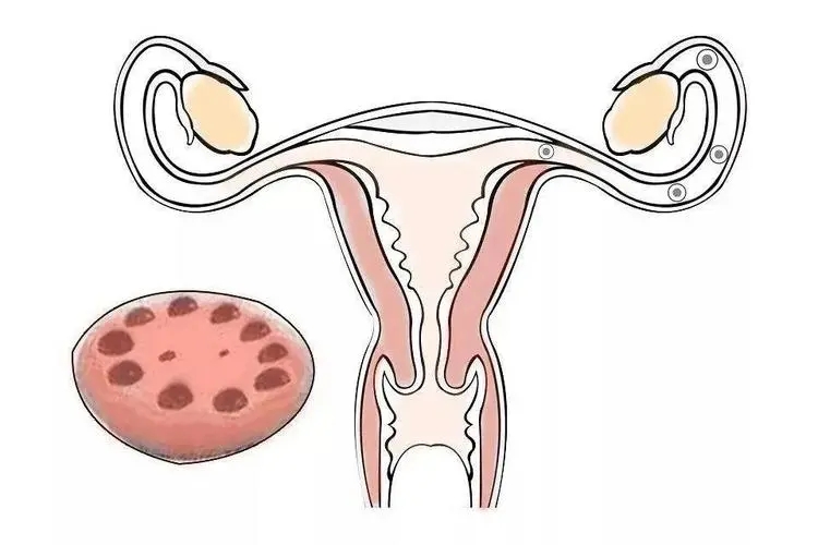 多囊卵巢综合征怎样“按需治疗”?